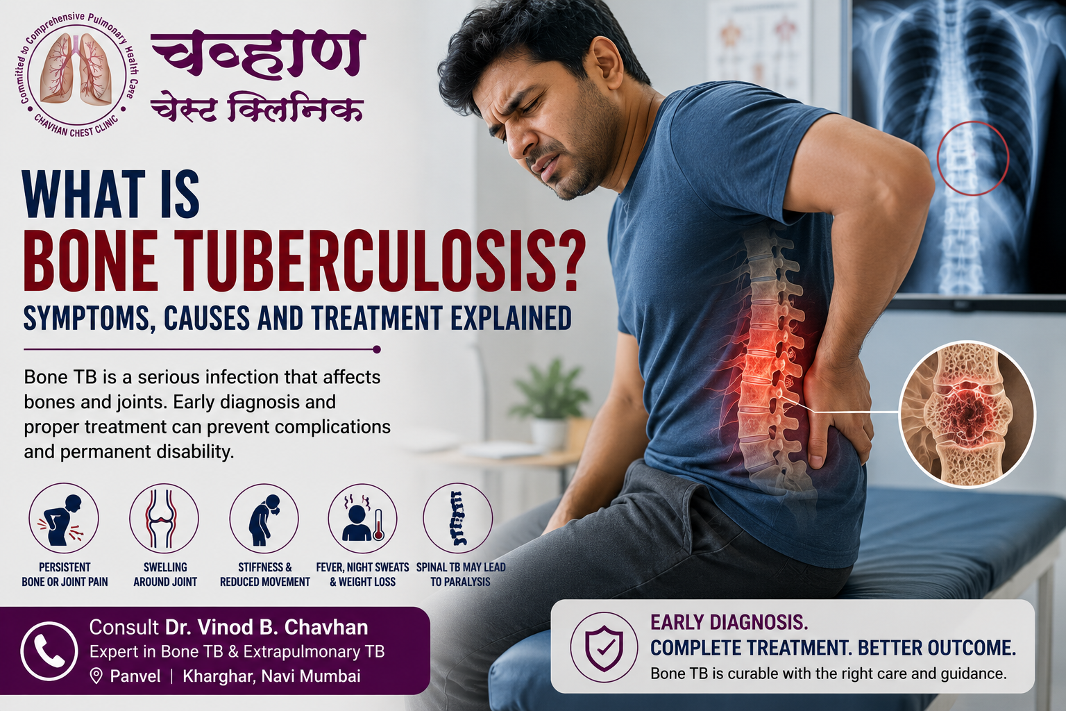 Bone tuberculosis symptoms including back pain, skeletal tuberculosis signs, spinal TB diagnosis, and bone tuberculosis treatment awareness.